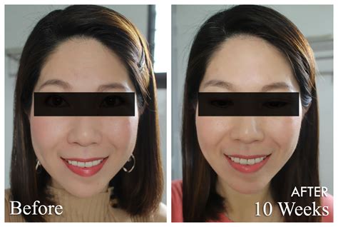 Ultherapy Results Before After Photos Show Slimmer Face And Sharper