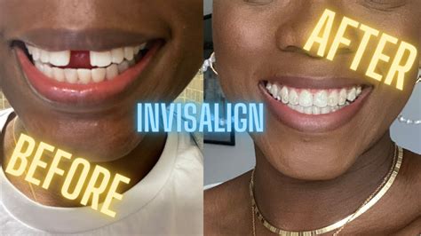 How To Close The Gap In Your Teeth Invisalign Before And After Review Youtube