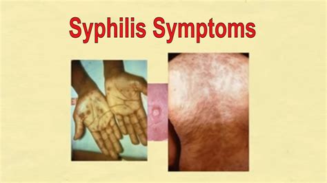 Syphilis Symptoms Symptoms Of Syphilis Std Youtube