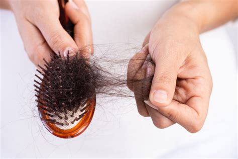 Top 48 Image Hair Loss Women Treatment Vn