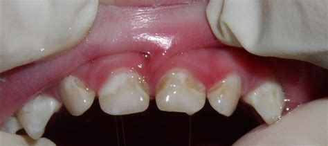 Black Lines On Teeth Molars Teethwalls