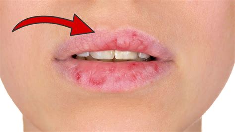 Diese 5 Hausmittel Helfen Bei Trockenen Lippen 💋 Youtube
