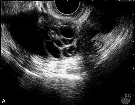 Can An Ultrasound Show Ovarian Cancer Cancerwalls