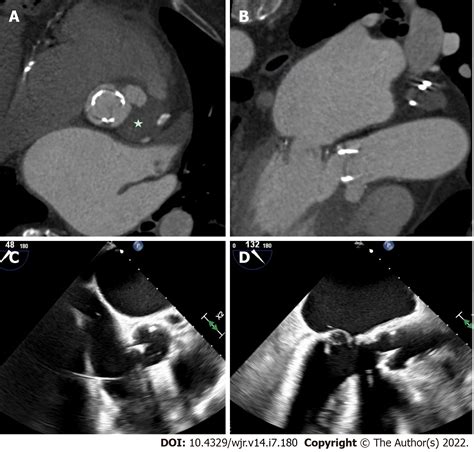 Expanding Utility Of Cardiac Computed Tomography In Infective
