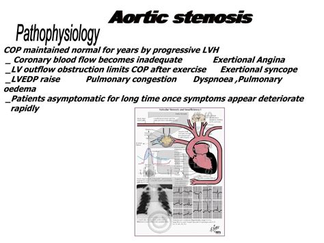 Ppt Aortic Stenosis Powerpoint Presentation Free Download Id3493665