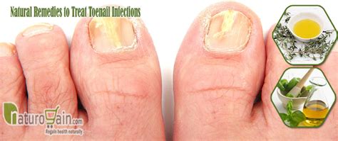 9 Best Home Remedies For Toenail Fungus To Prevent Infection