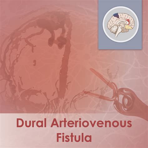 Dural Arteriovenous Fistula Free Audio Free Download Borrow And