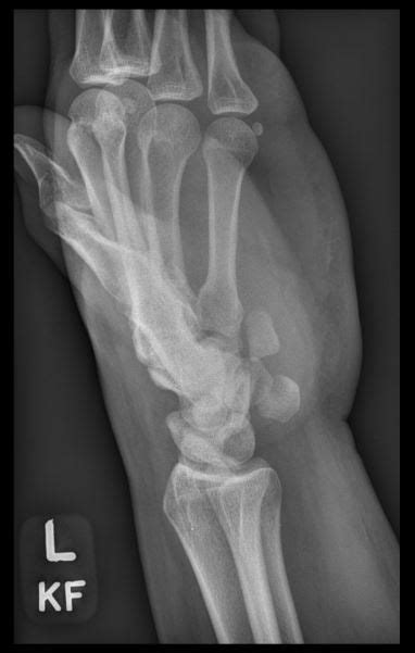 Hook Of Hamate Fracture Image