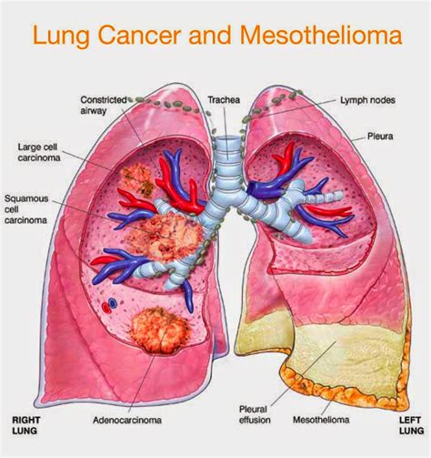 All About Mesothelioma