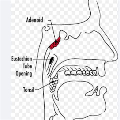 Adenoidectomy Surgery Guide Expert Advice