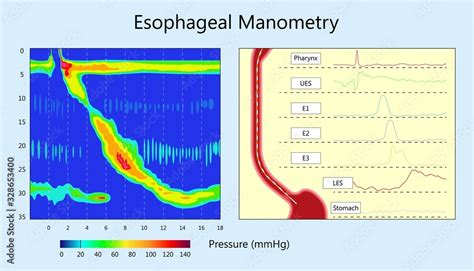 Esophageal Manometry Hot Sex Picture