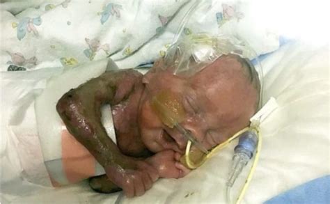Miracle Baby Born With No Skin And Then Defies All Odds To Survive