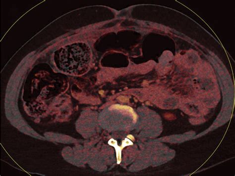Use Of Dual Energy Ct And Iodine Maps In Evaluation Of Bowel Disease
