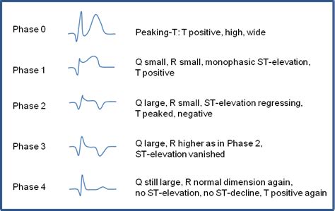 Electrocardiographic Phases Of Stemi Adapted From The Pschyrembel