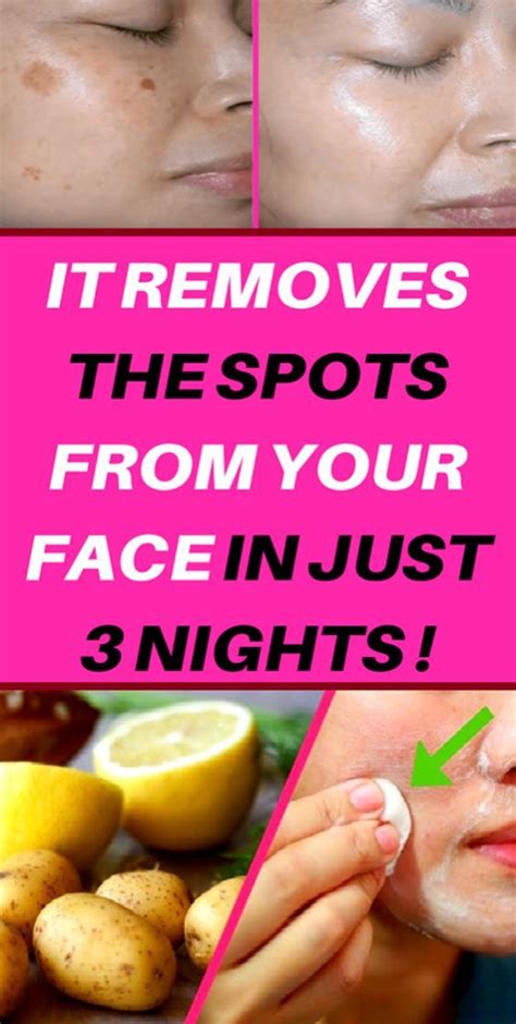 How To Get Rid Of Age Spots On Face Age Spots On Face Spots On Face