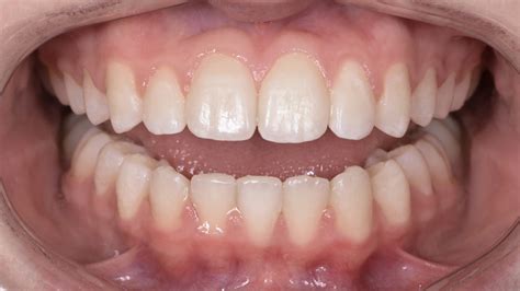 Lower Incisor Extraction An Alternative Approach E Line Orthodontics