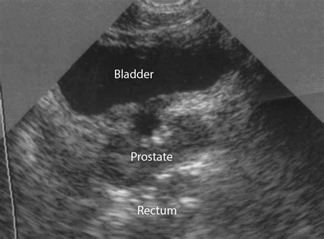 Normal Bladder Ultrasound