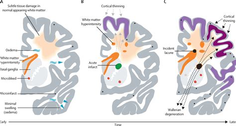 Small Vessel Disease Mechanisms And Clinical Implications The Lancet