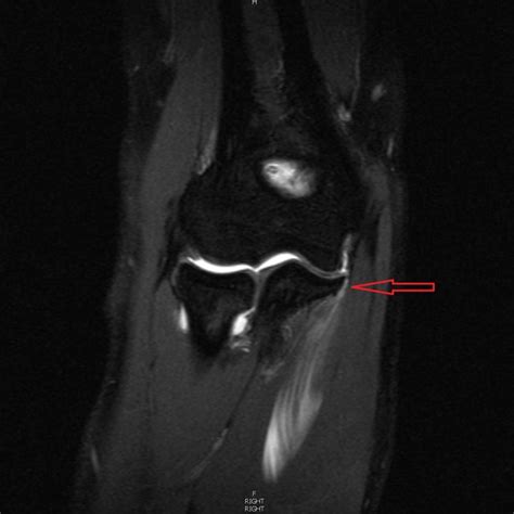 Right Elbow Mri With Contrast Showing Complete Tear Of The Ucl