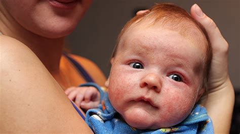 Baby Eczema Atopic Dermatitis On Your Infant Symptoms And Treatment