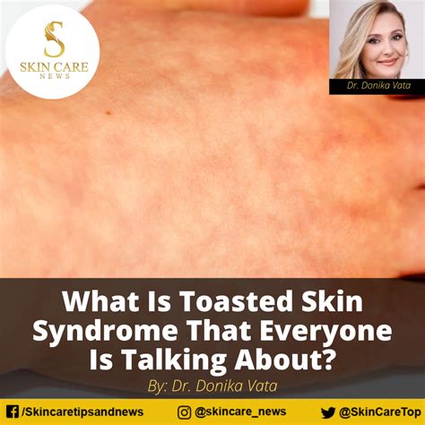 What Is Toasted Skin Syndrome That Everyone Is Talking About