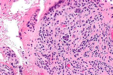 Giant Cell Tumor Of Tendon Sheath Gctts