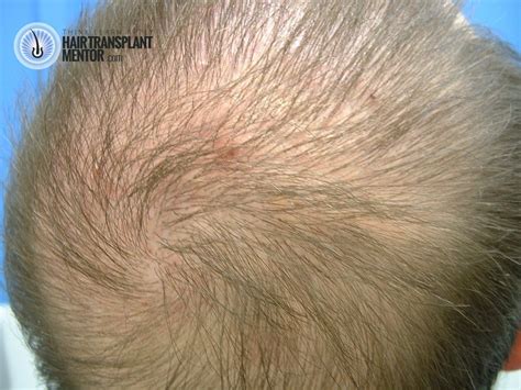 Dallas hair transplant surgeon dr. Hair Transplant Growth Timeline-New Hair at Two Months?