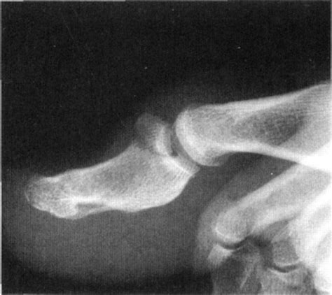 Avulsion Fracture Of The Great Toe A Case Report Andrew J Rapoff