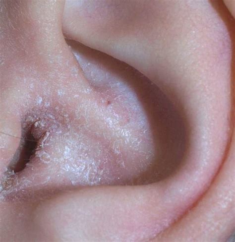 Ear Eczema Symptoms Causes And Treatment