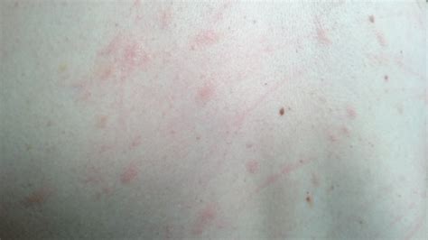 Itchy Red Bumps On Stomach And Backwhat Are These Babycenter