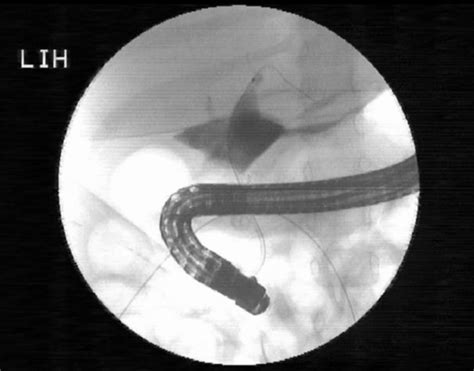 Initial Ercp Showing A Leaking Bile Duct Biliary Sphincterotomy And