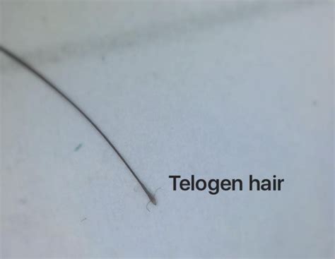 Telogen Hairs Not Only In Telogen Effluvium — Donovan Hair Clinic