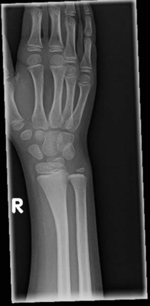 An Year Old Boy With Forearm And Wrist Pain After A Fall Journal Of Urgent Care Medicine