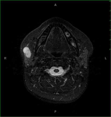 Benign Mixed Tumor Parotid Pleomorphic Adenoma Neuro Mr Case