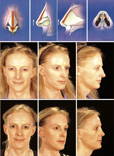 The Role Of Nasal Feminization Rhinoplasty In Male To