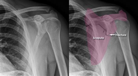 Trauma X Ray Upper Limb Gallery 1 Scapula Fractures