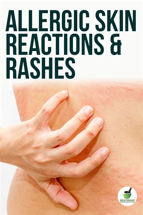 Allergic Skin Reactions Rashes Welts Itchy Irritated Skin Natural