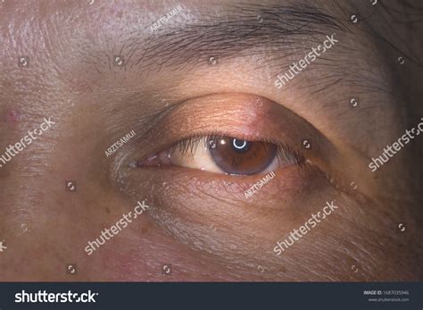 Close Stye Hordeolum Chalazion Eyelid Infection Stock Photo 1687035946