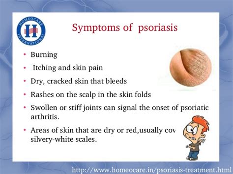 Psoriasis Homeopathic Treatment Dorothee Padraig South West Skin