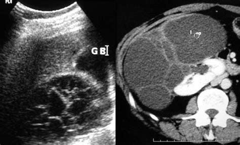 The Radiology Assistant Kidney Cystic Masses