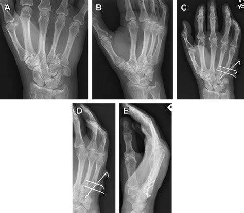 Metacarpal And Phalangeal Fractures In Athletes Clinics In Sports