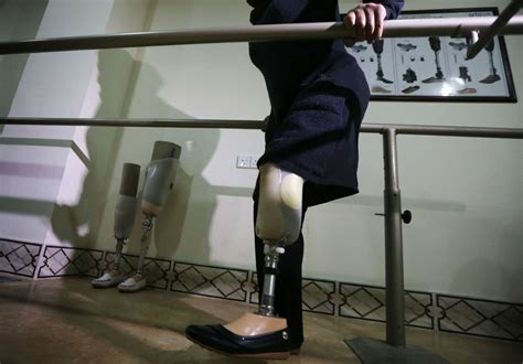 Woman Decides To Have Her Leg Amputated Years After Snapping It In A Freak Accident Tech Times