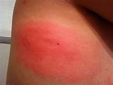 Red Wasp Sting Treatment Pictures