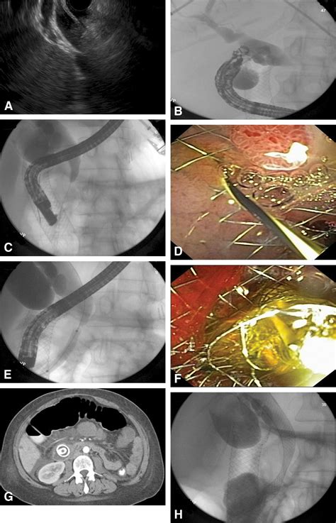 Eus Guided Biliary Drainage For Patients With Malignant Biliary Obstruction With An Indwelling