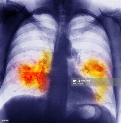 Chest Xray Showing Lung Cancer High Res Stock Photo Getty Images