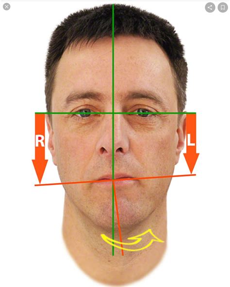 Is It Possible To Treat Misaligned Jaw Through Mewing Should I Push