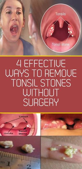4 Effective Ways To Remove Tonsil Stones Without Surgery Wellness
