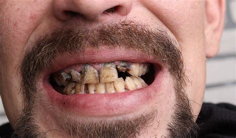 What Health Problems Can Result In Bad Teeth