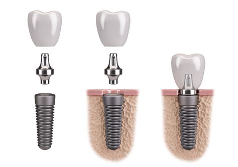 De qué material son los implantes dentales