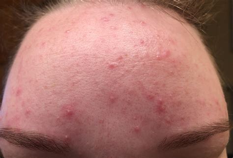Acne Been Struggling With This For A While Anyone Successfully Deal